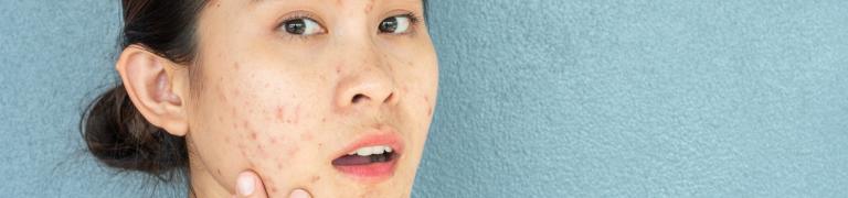 Natuurlijke oplossing voor acne