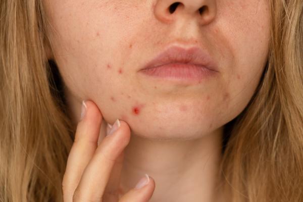 De invloed van stress op je huid